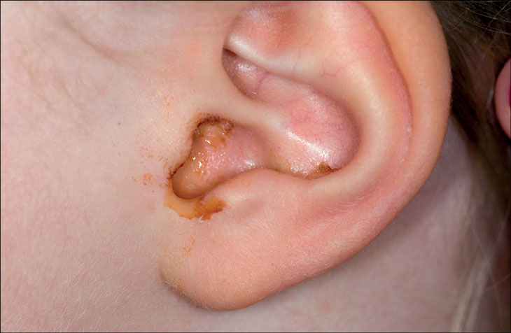 Dấu hiệu viêm tai giữa ở trẻ em  mà bố mẹ cần lưu ý
