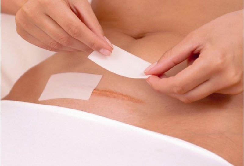 Giữ Vết Mổ Sạch Sẽ để Ngăn Ngừa Nhiễm Trùng