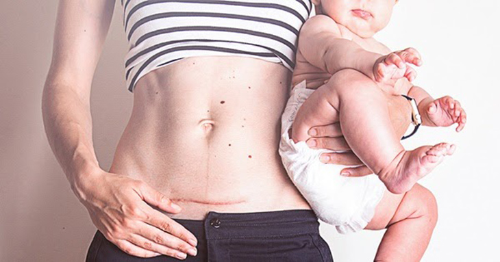 Hiểu về sinh mổ lần hai và những khác biệt