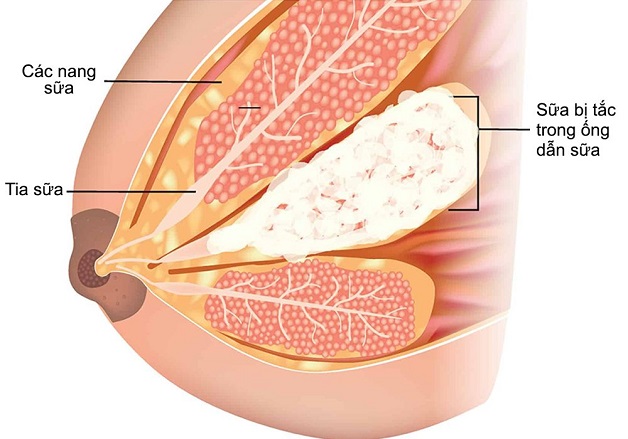 Tắc Tia Sữa Là Gì