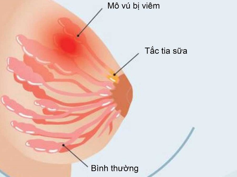 Nguyên Nhân Khiến Mẹ Bị Tắc Tia Sữa Nhiều Lần
