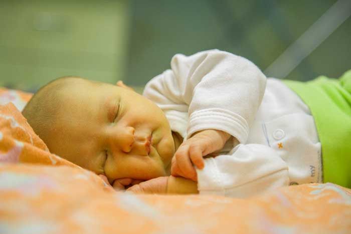 Dấu hiệu nhận biết trẻ sơ sinh bị vàng da và cách điều trị